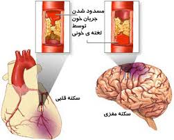 پورتال برنامه ملی درمان سکته حاد قلبی و مغزی